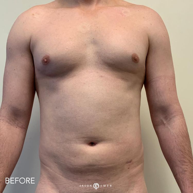 360 HD Lipo Male Before