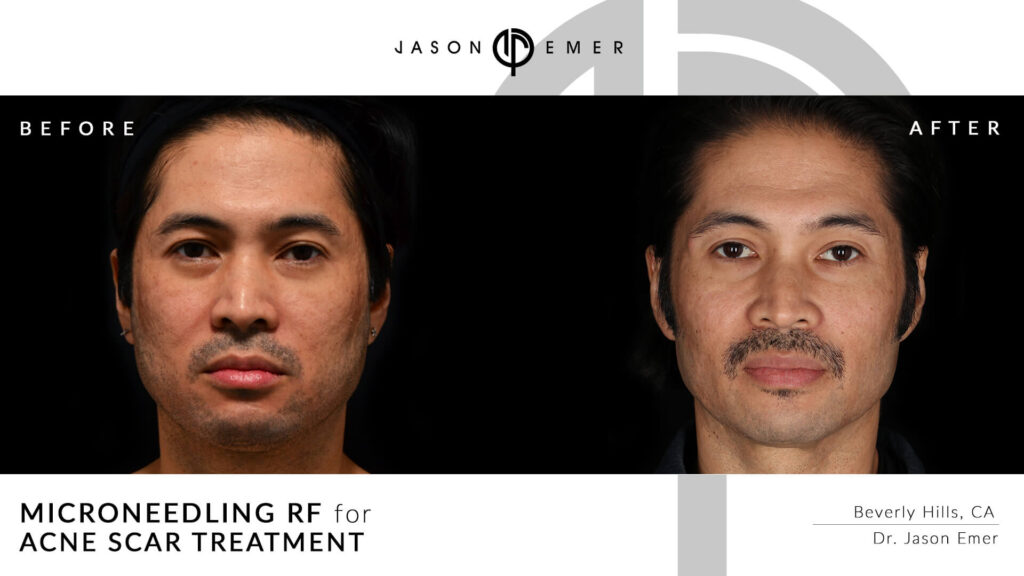 Microneedling for acne scar treatment | Before and After | Dr. Jason Emer MD | | Beverly Hills, CA