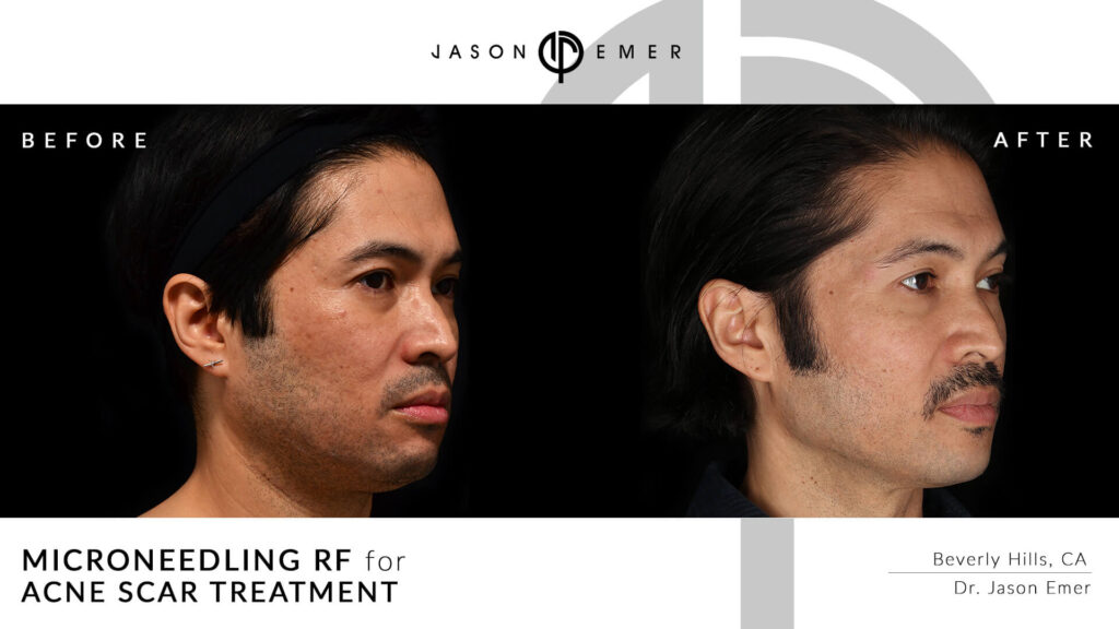 Microneedling for acne scar treatment | Before and After | Dr. Jason Emer MD | | Beverly Hills, CA