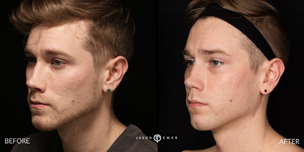 Chemical Peel | Before and After | Dr. Jason Emer MD | | Beverly Hills, CA