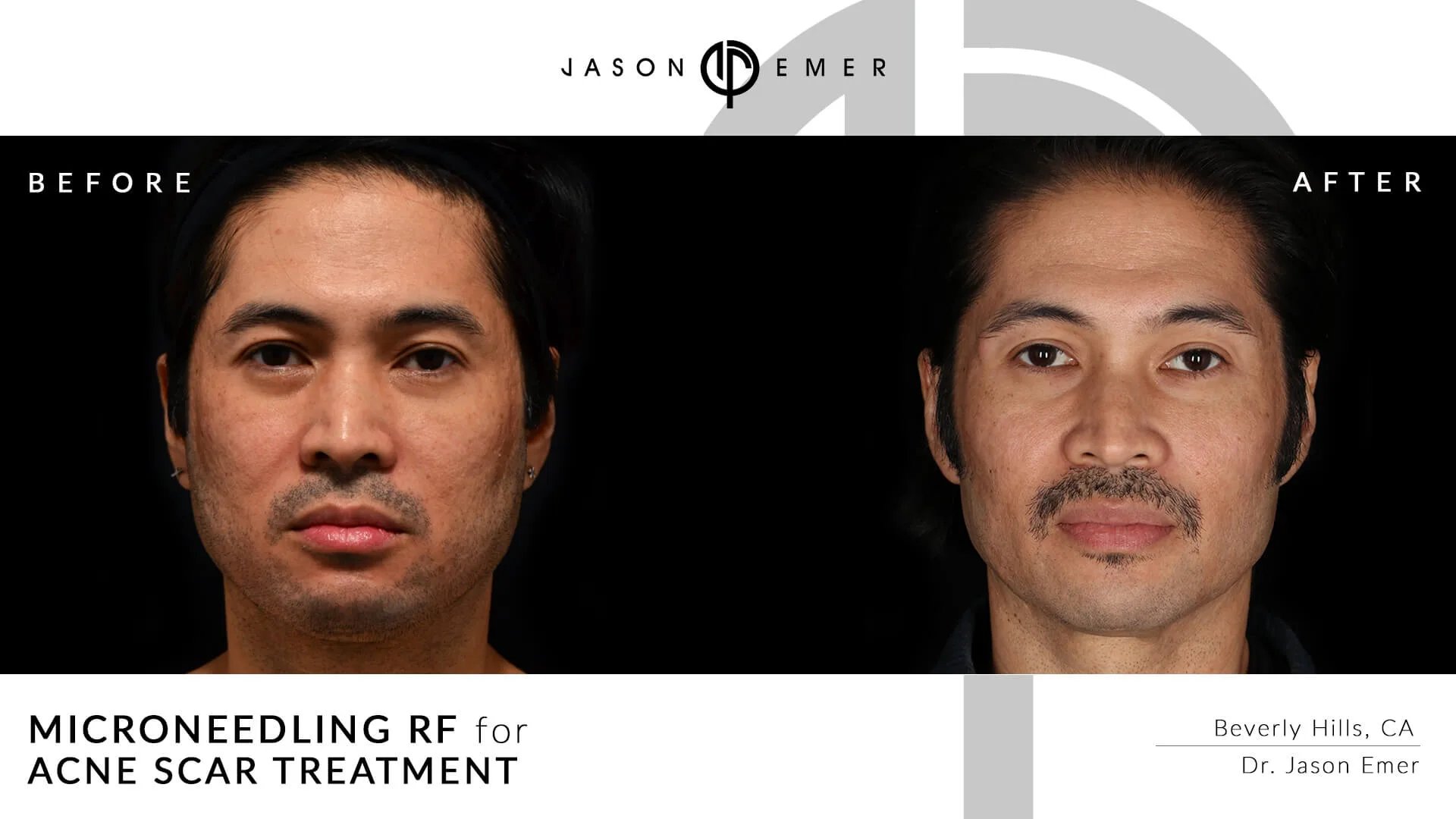 Microneedling for acne scar treatment | Before and After | Dr. Jason Emer MD | | Beverly Hills, CA