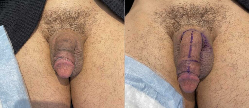 Male enhancement penile filler before and after penis enlargement results 122