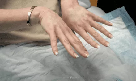 HAND REJUVENATION USING FILLERS | BEFORE & AFTER RESTYLANE INJECTIONS