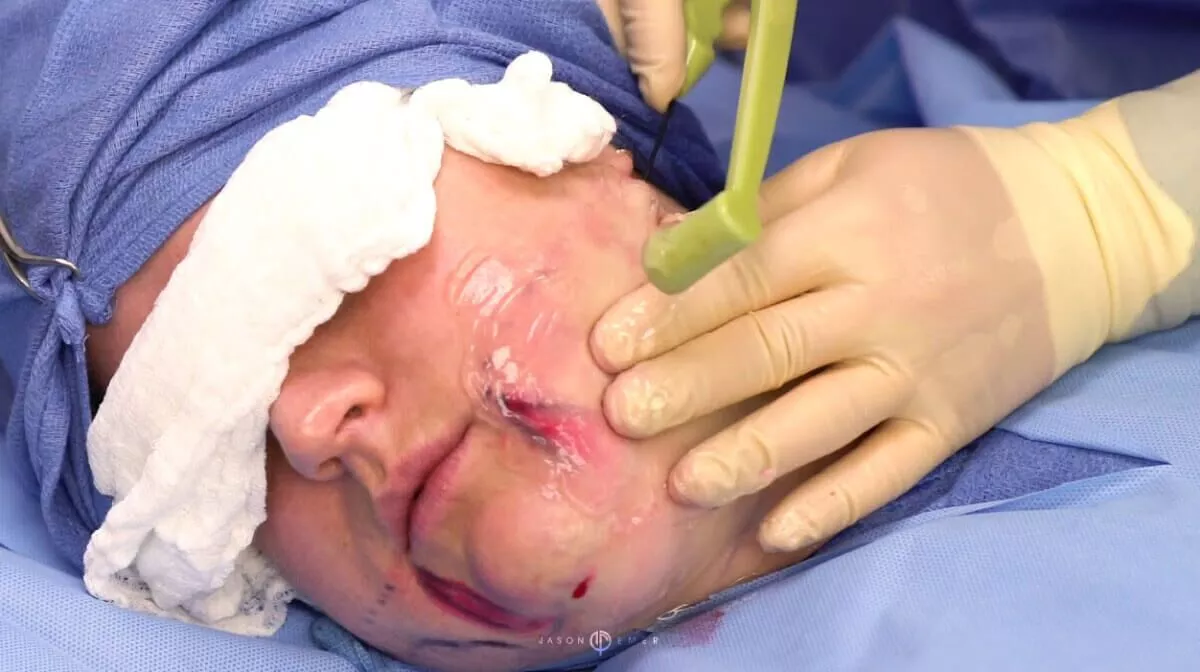 FACETITE PROCEDURE | MINIMALLY INVASIVE MINI FACELIFT & NECKLIFT