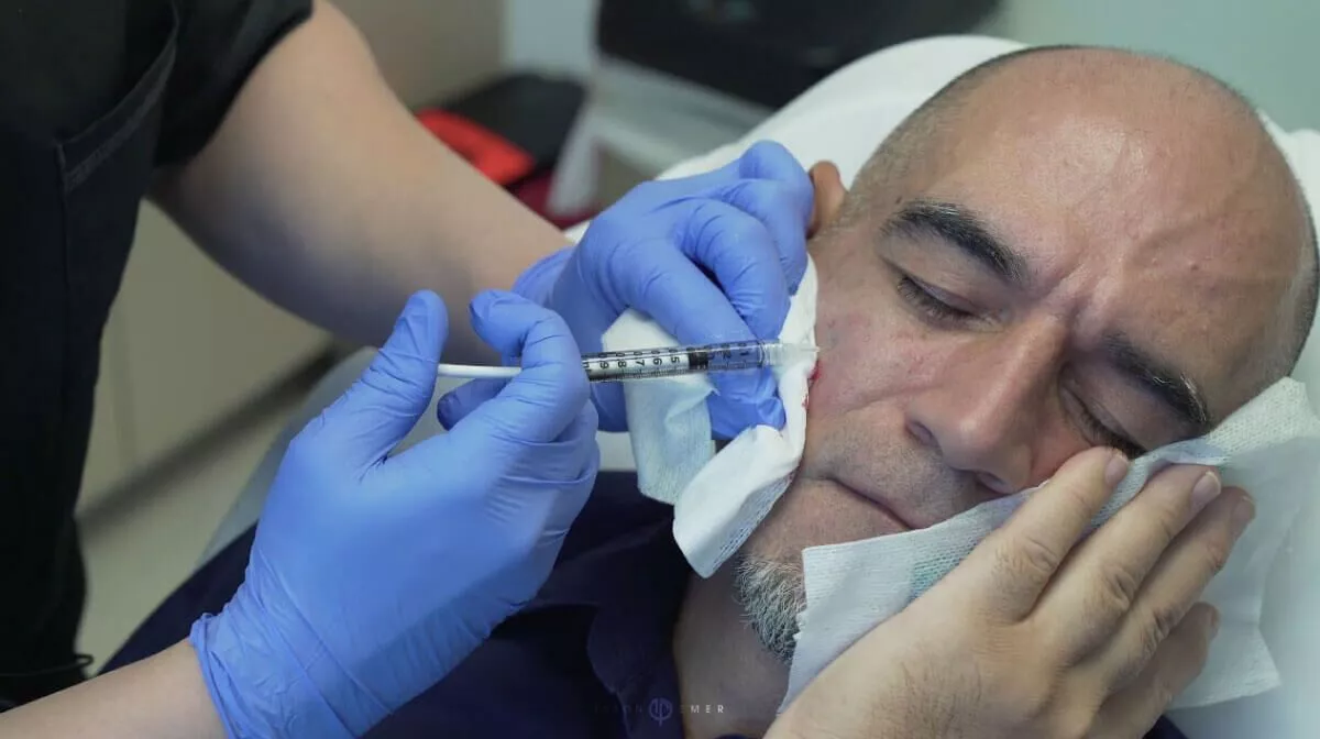 SILICONE INJECTIONS FOR SCARS (CHEEK)