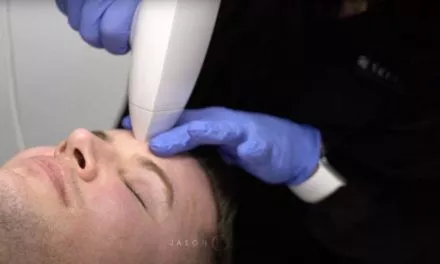 FRACTIONAL RADIO FREQUENCY SKIN RESURFACING