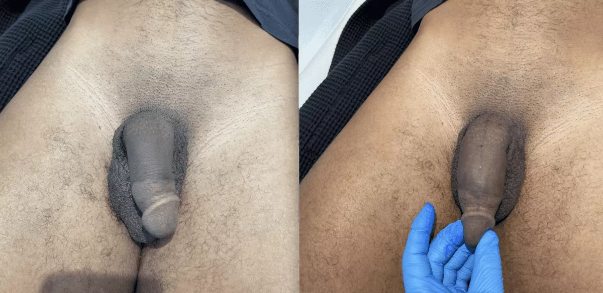 Before-and-After-Penis-Filler-Gallery-2-June-16-e1636651910466