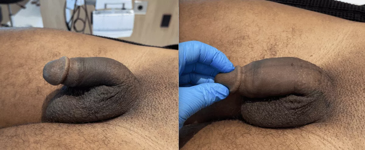 Before-and-After-Penis-Filler-Gallery-June-16-e1636651899623