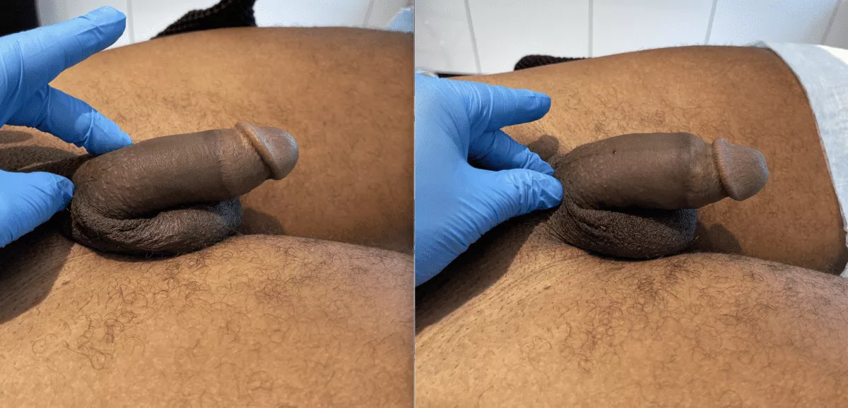 Before-and-After-Photo-Penis-Filler-Gallery-3-June-16--e1636651917748