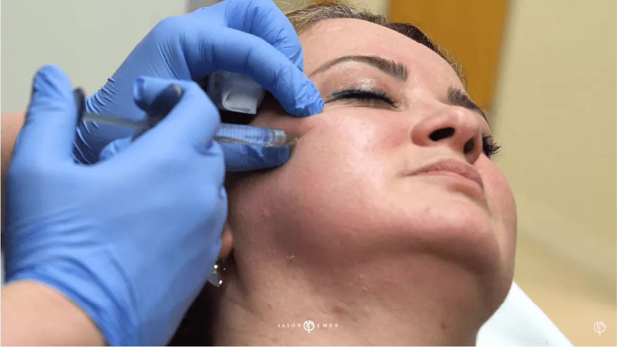 IRIS CHEEK, CHIN, LIP FILLER FEMALE FACIAL SCULPTING