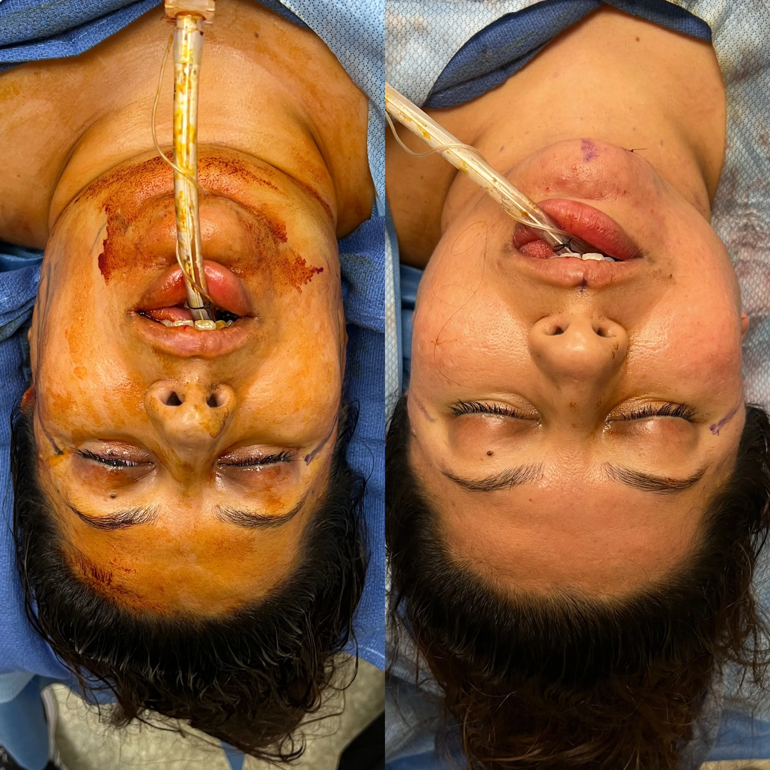 Female-face-and-neck-lift-patient-2-scaled
