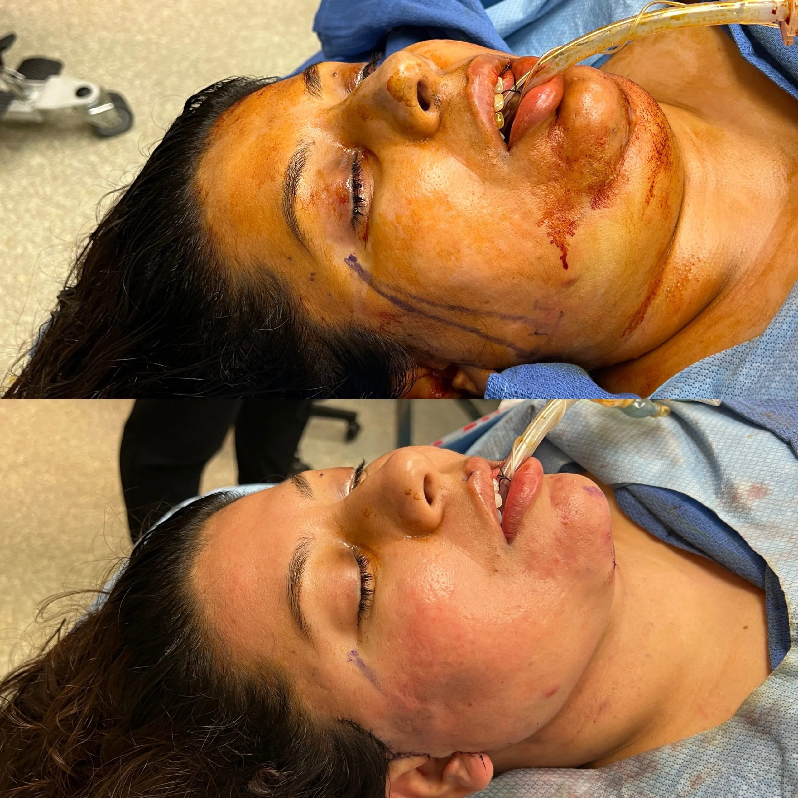 Female-face-and-neck-lift-patient-3-scaled