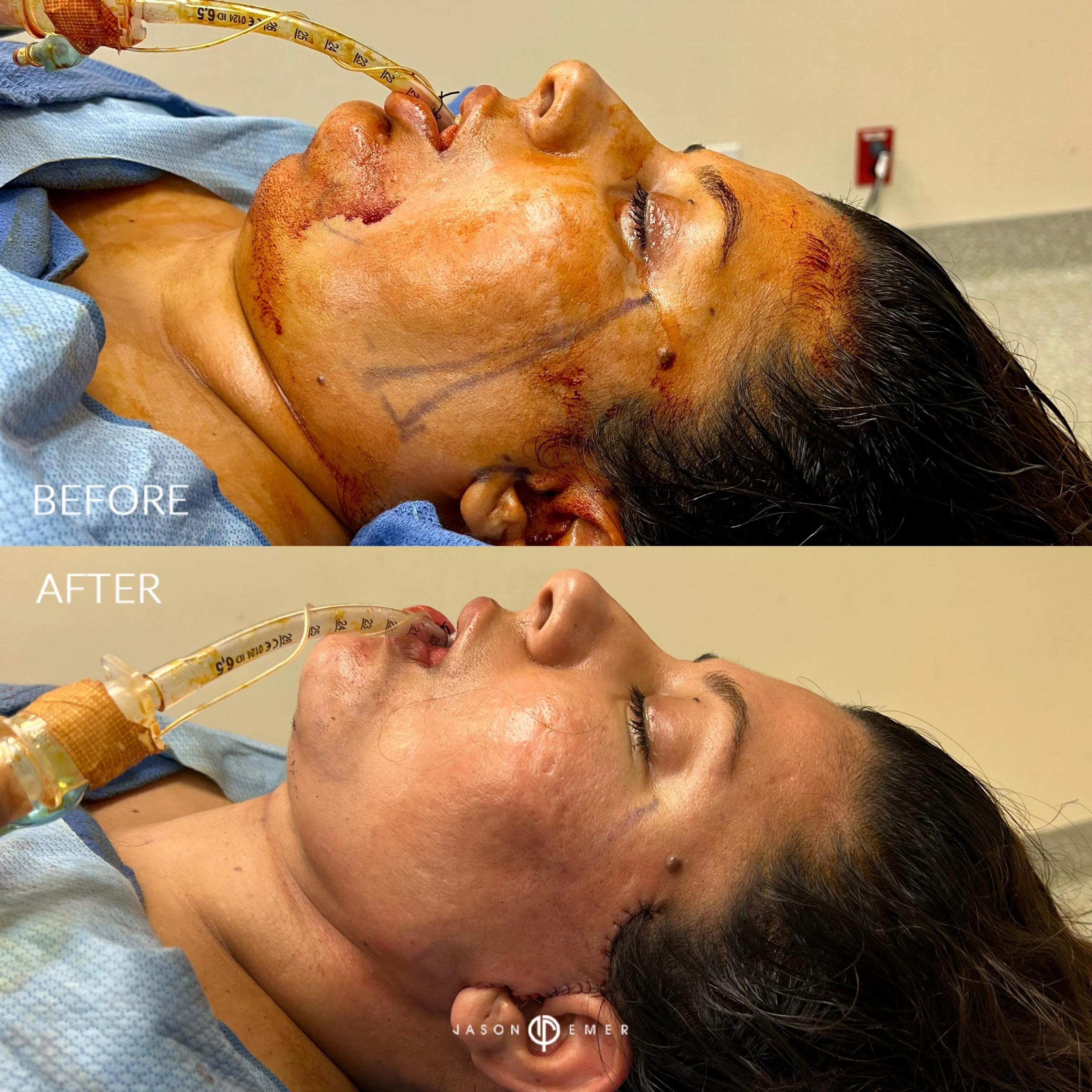 Female-face-and-neck-lift-patient-scaled
