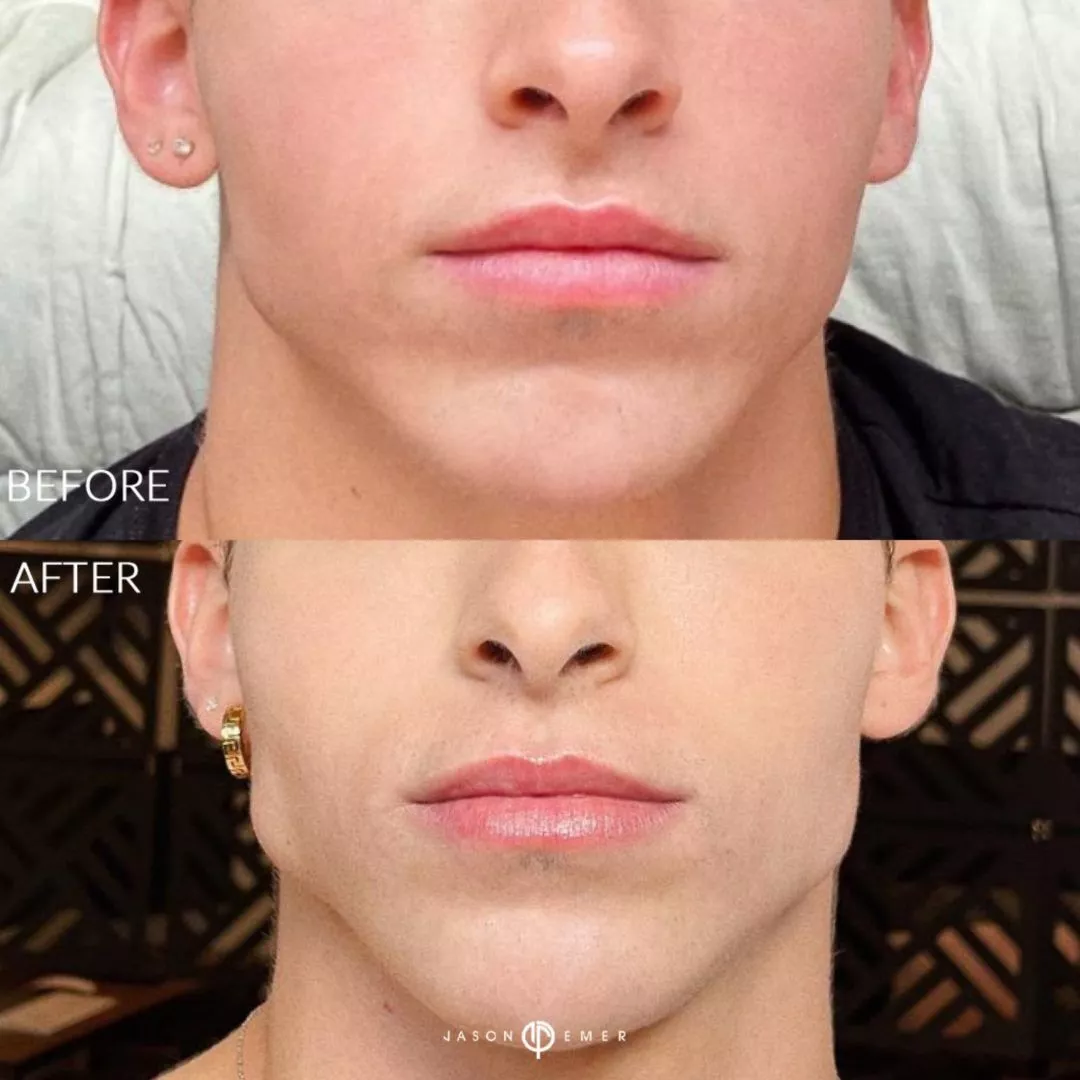 Male-Facial-Sculpting-1B