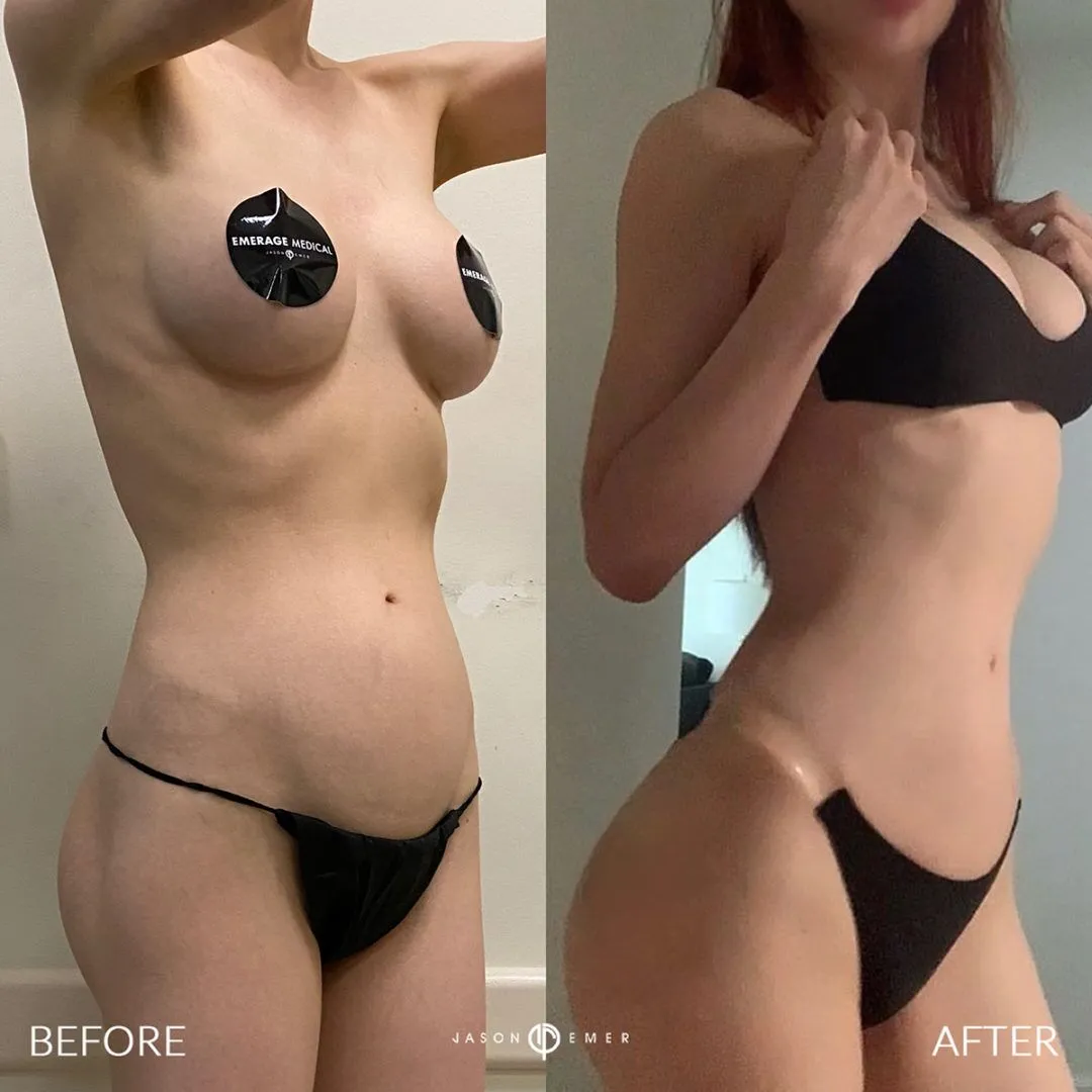 non surgical bbl SLIM-SUPERMODEL-LIPO-BELLALIFT-BXA-1080x1080