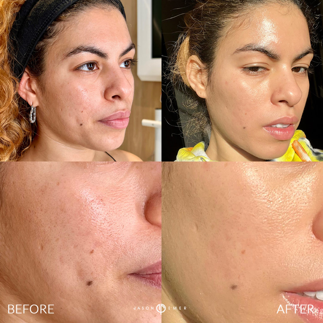 chemical-peel-bxa-1-1080x1080