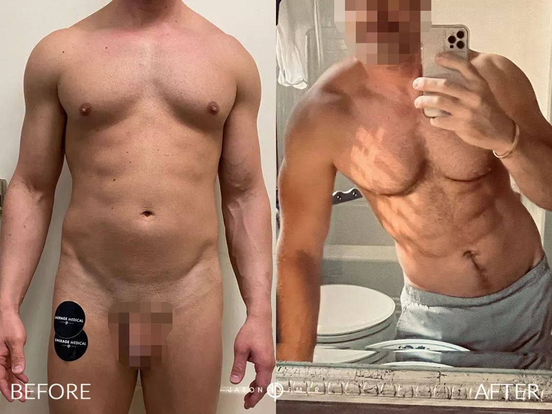 fat-grafting-to-chest-bxa-1080x810
