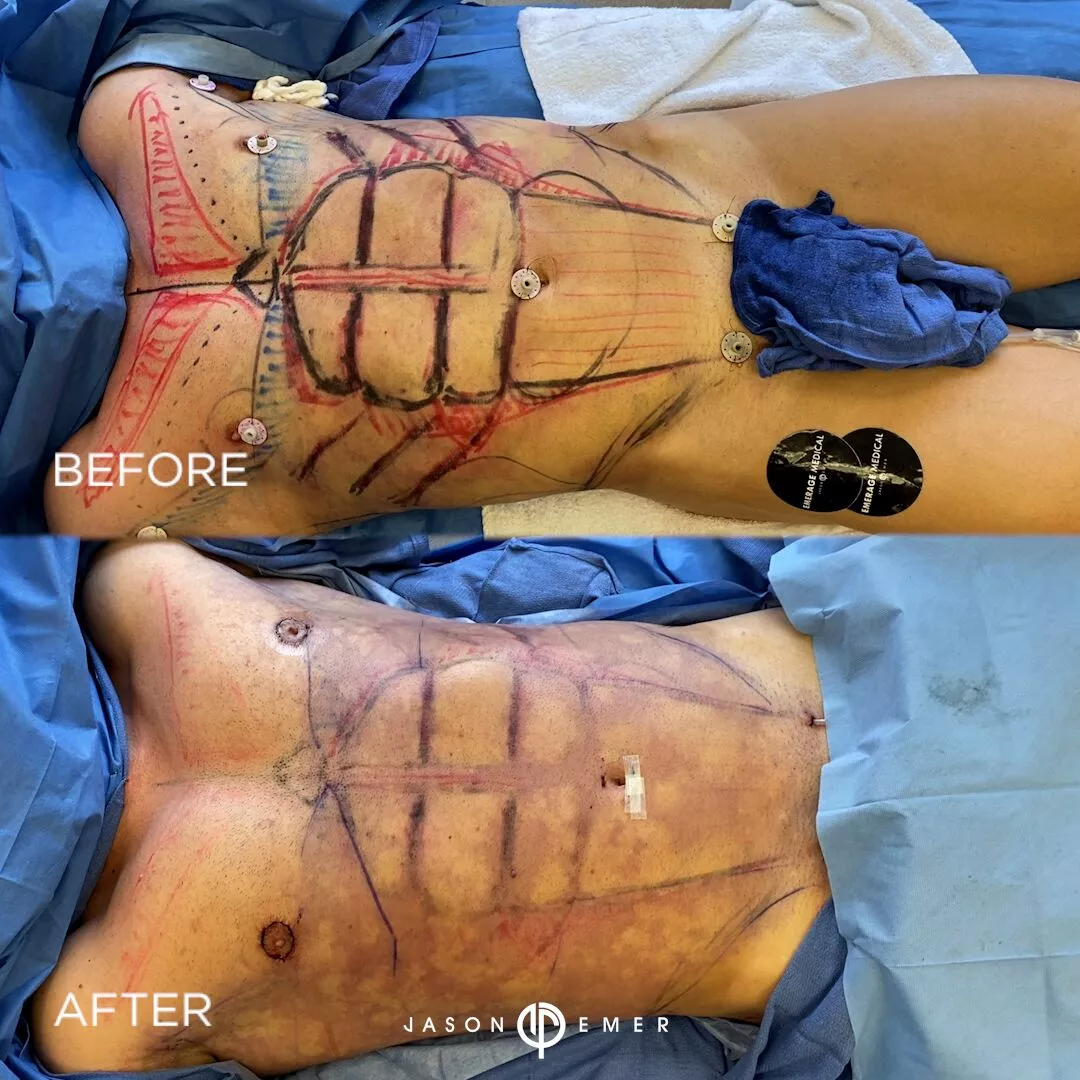 fat-grafting-to-chest-bxa2