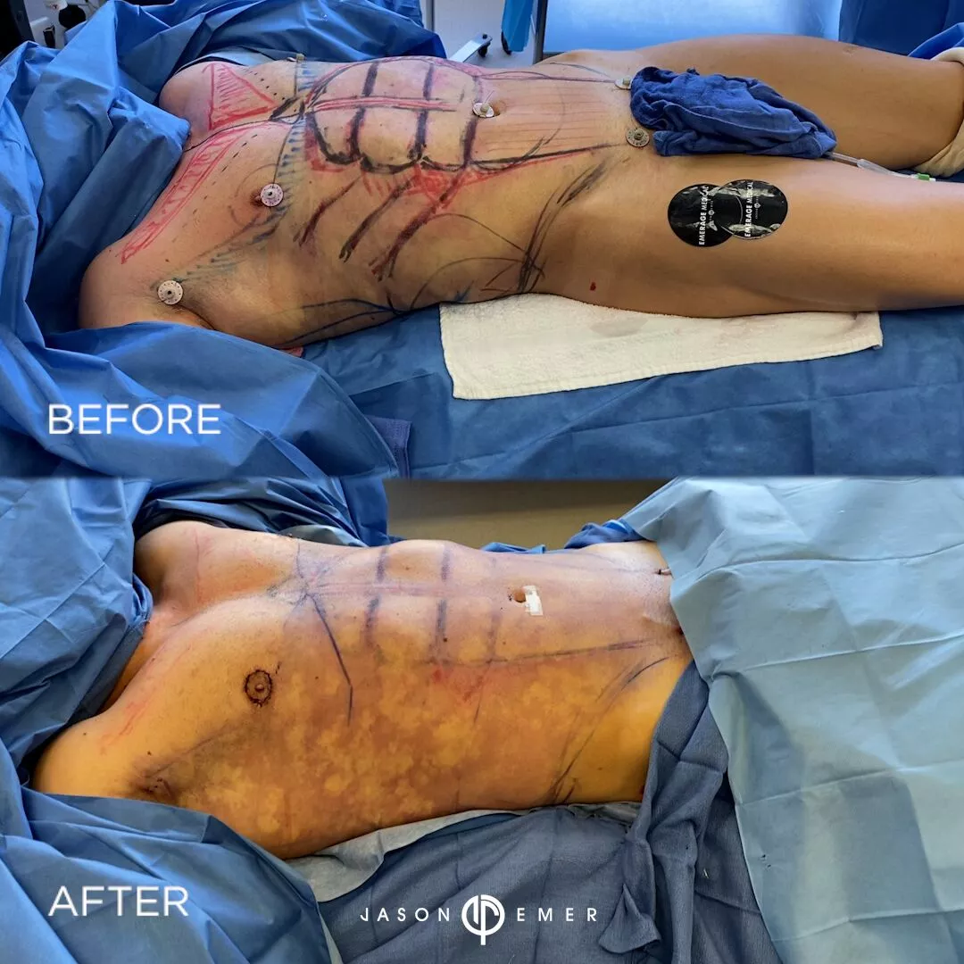 fat-grafting-to-chest-bxa3