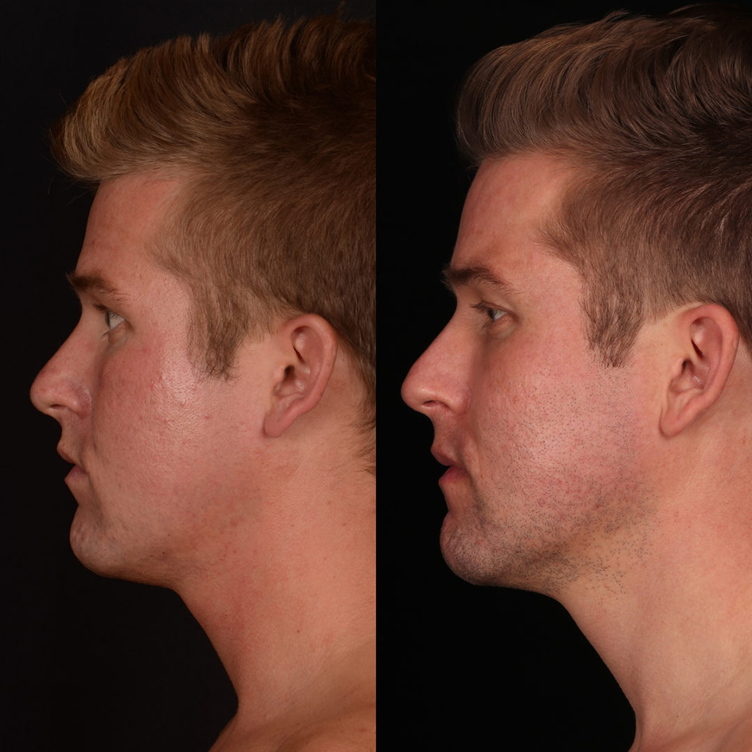 lasers-bxa-7-1080x1080