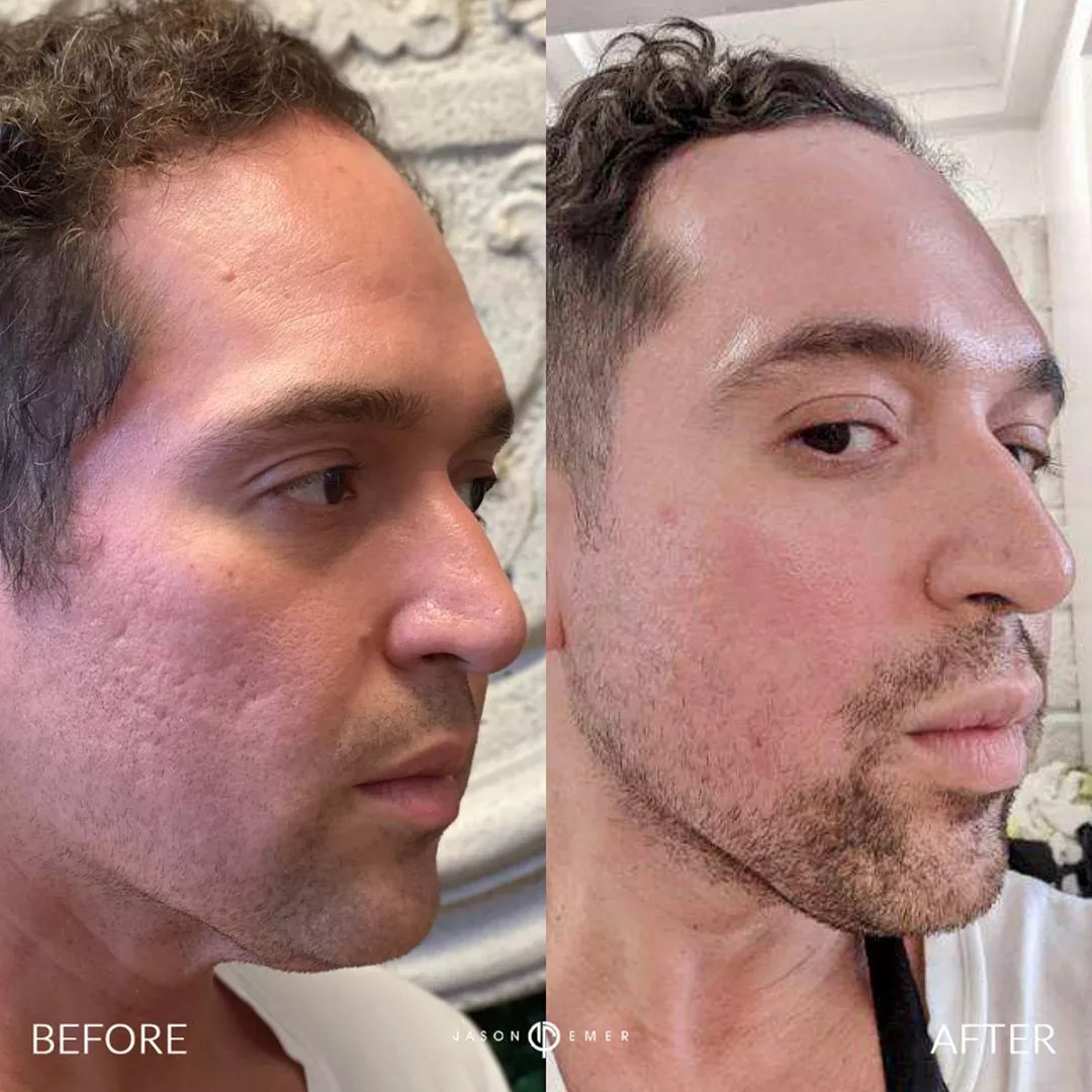 microneedling-RF-bxa-1-1080x1080