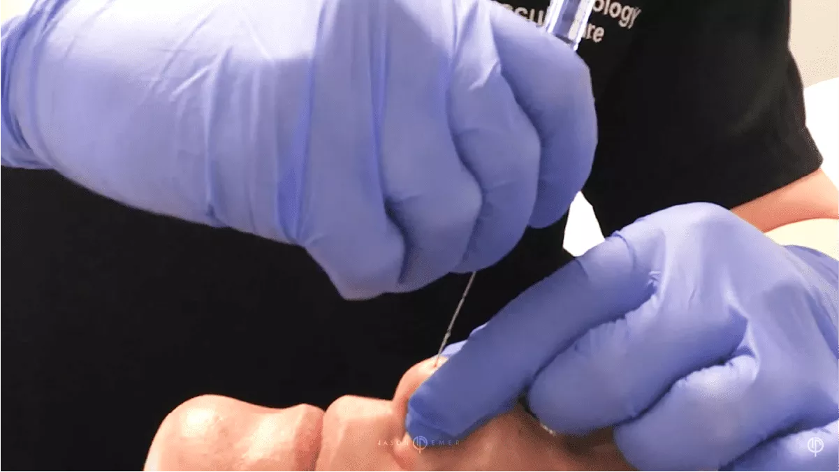 NON-SURGICAL RHINOPLASTY WITH FILLER