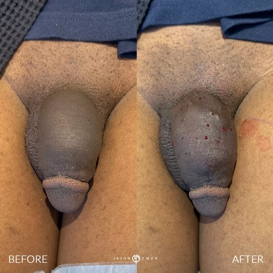 penile-filler-before-after-9092-1-3