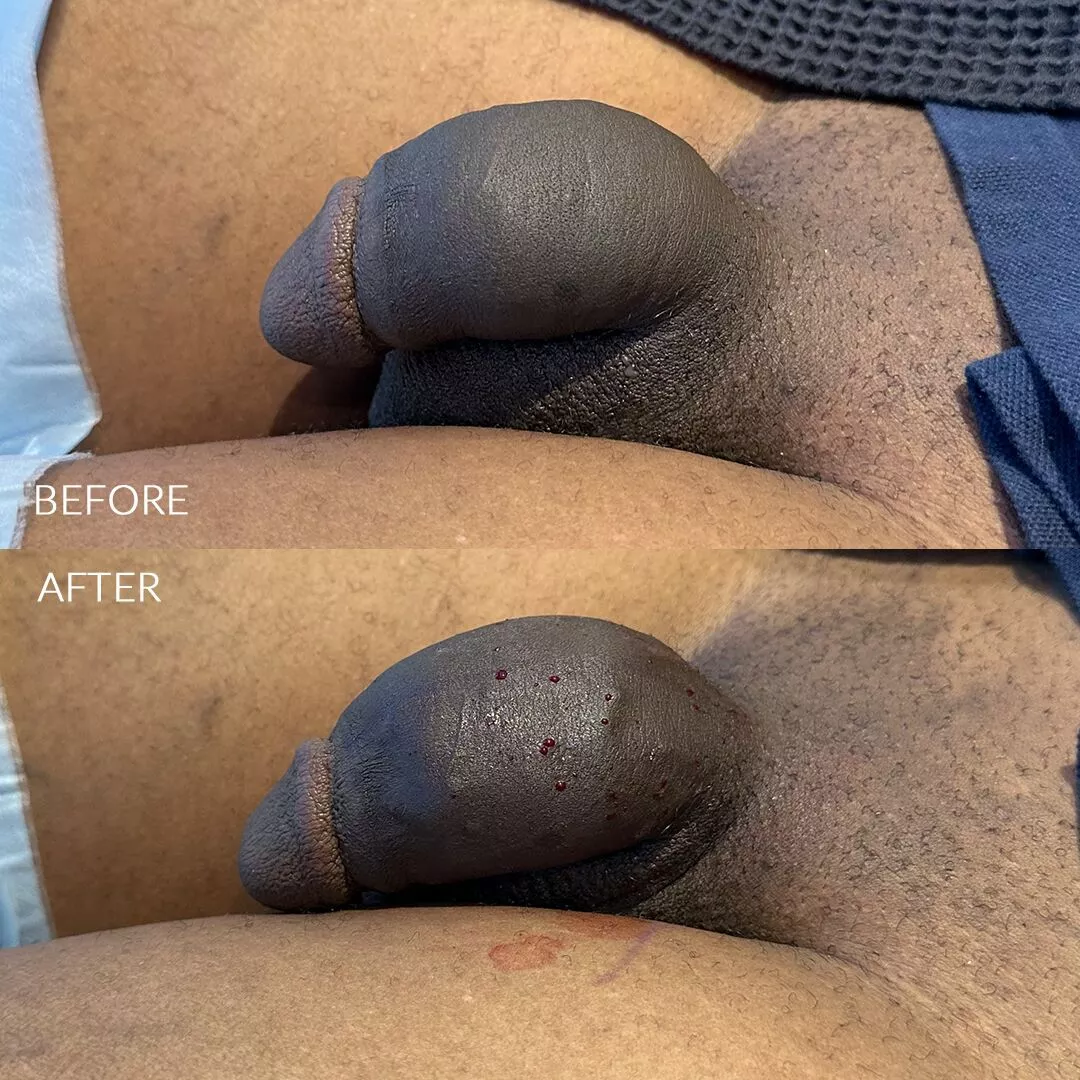 penile-filler-before-after-9092-3-3