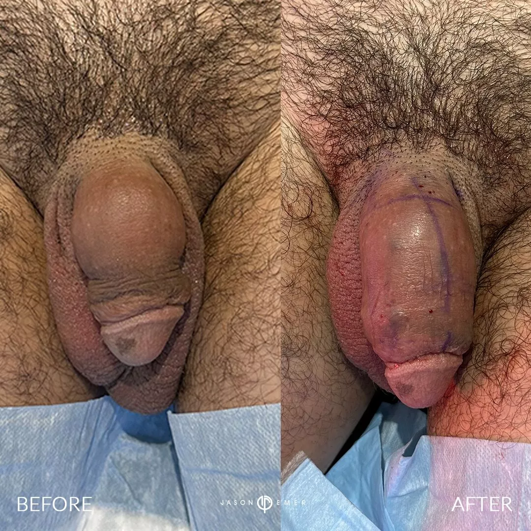 penile-filler-revision-before-after