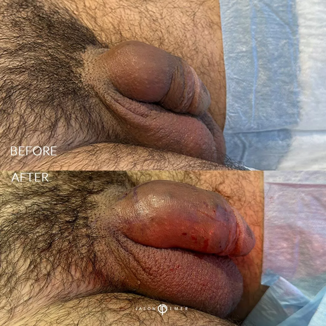 penile-filler-revision-before-after2
