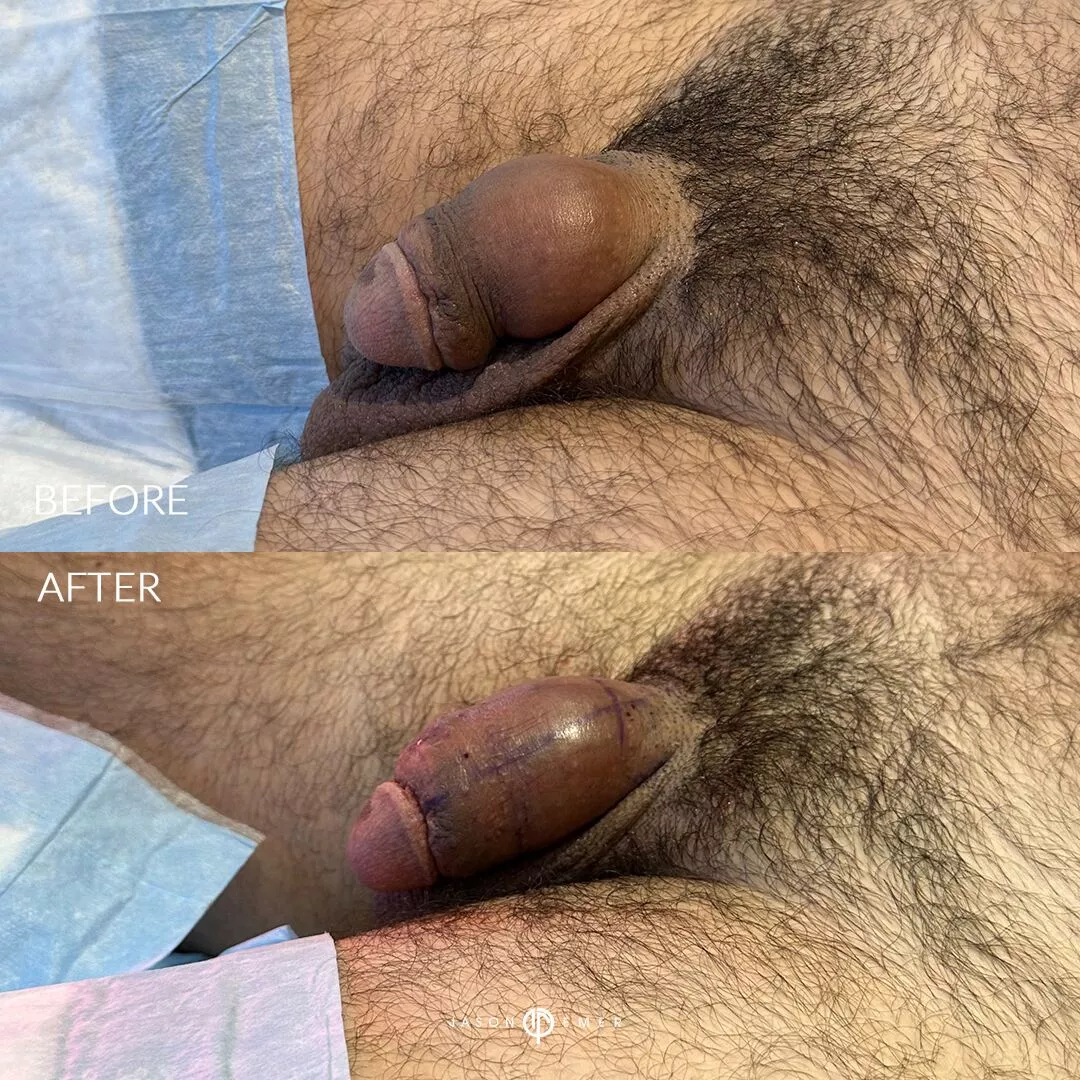 penile-filler-revision-before-after3