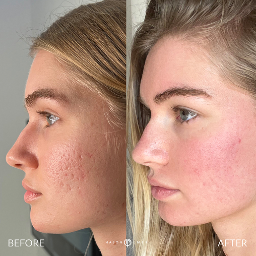acne scars