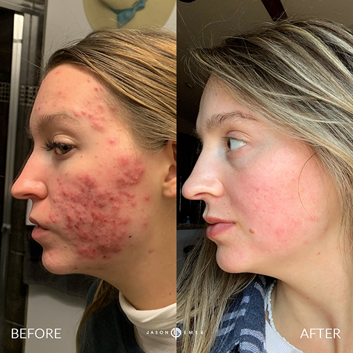 Acne Treatment