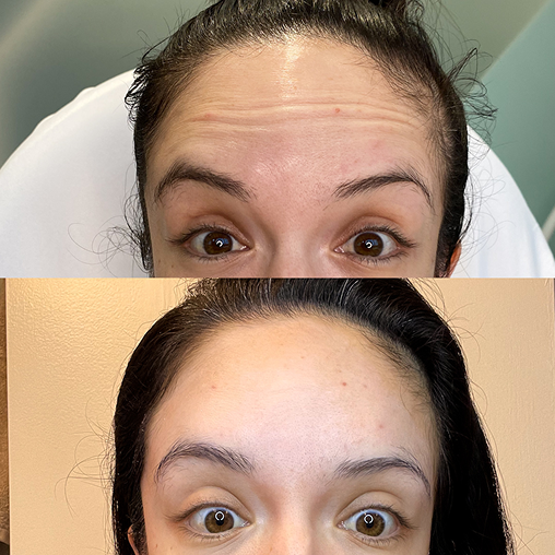 Botox