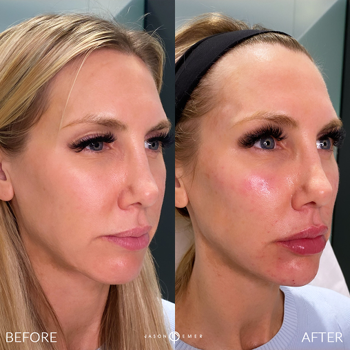 Female Facial Sculpting
