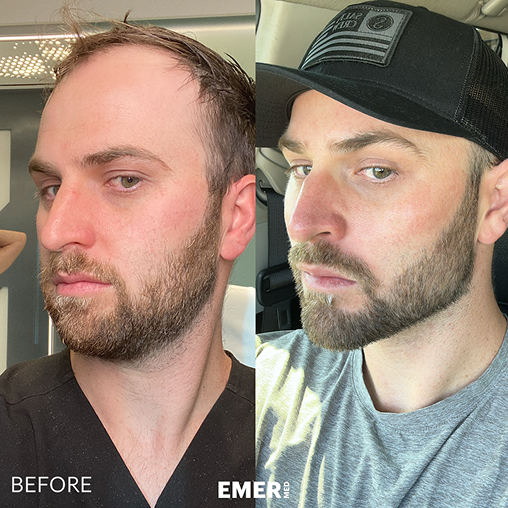 Male Facial Sculpting