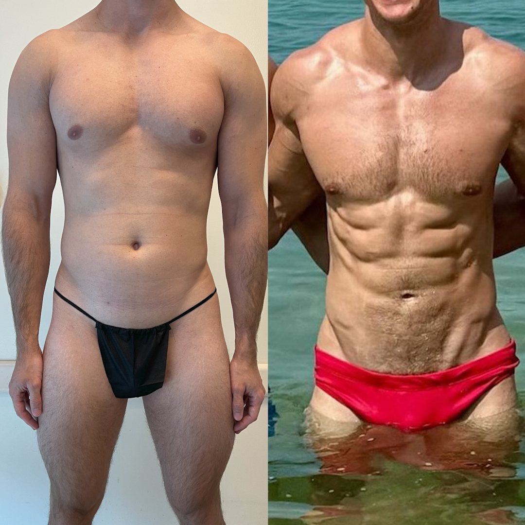Before and after lower-abdomen fat reduction with improved waist definition
