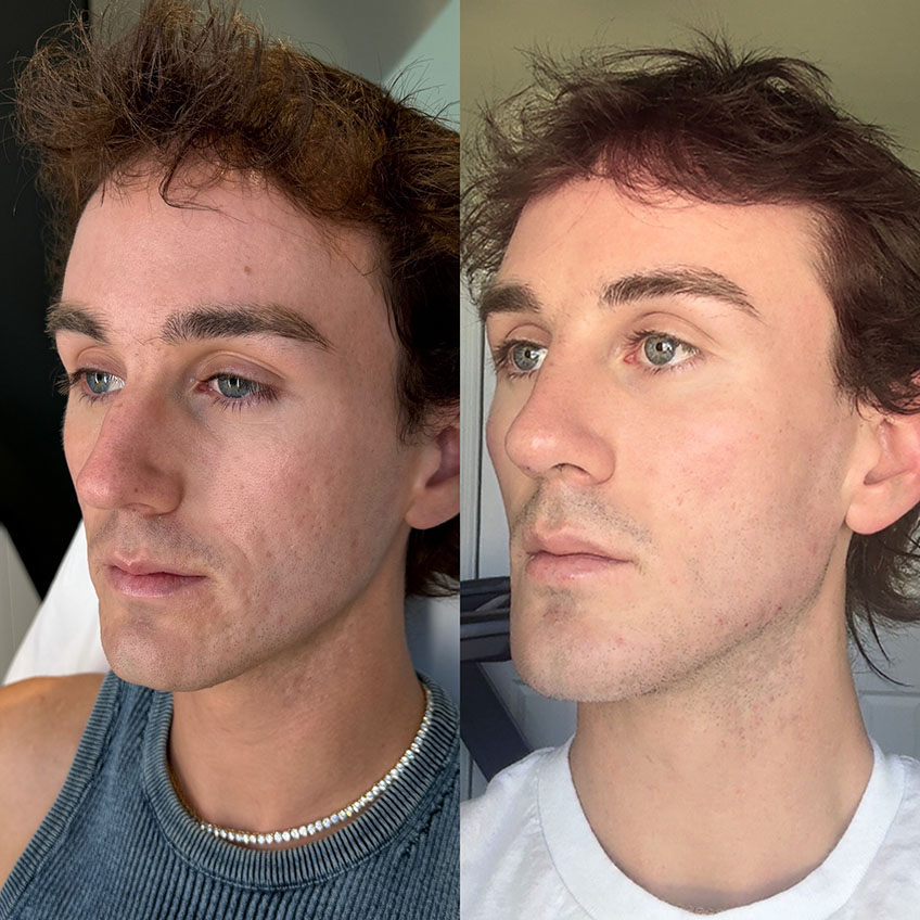 Before and after facial restoration showing balanced, natural volumization