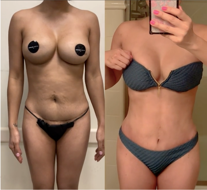 Before and after tummy tuck revision showing lowered scar and improved umbilical balance