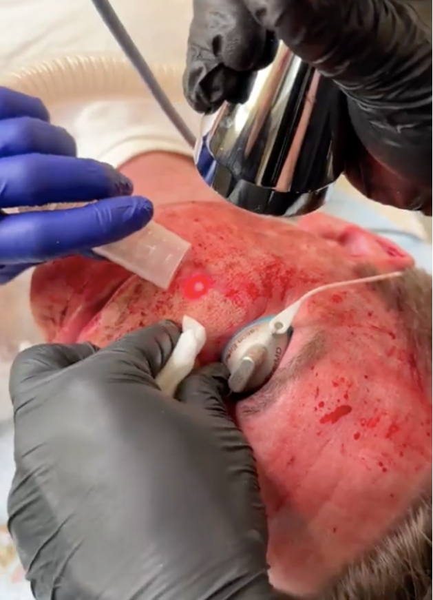 Fractional laser device treating a post-Mohs facial scar