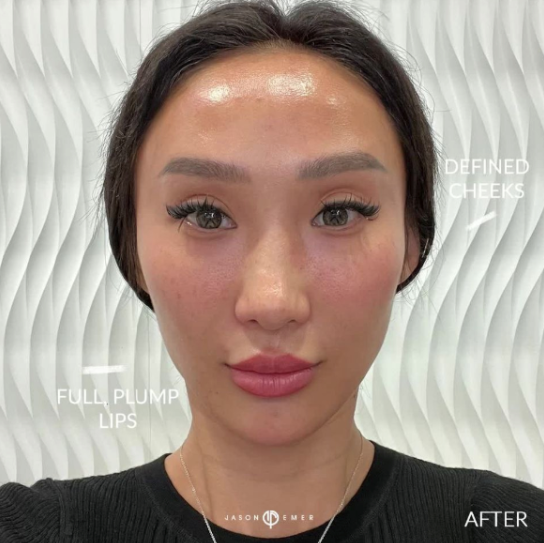 Heart-shaped facial contour using subtle cheek and chin filler results
