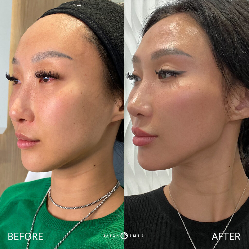 female-facial-sculpting-of-the-cheeks,-nasolabial-folds-and-chin-with-fillers
