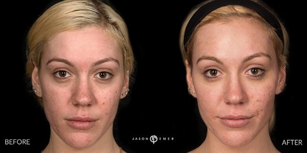 Laser and RF skin resurfacing | Before and After | Cosmetic Dermatologist | Dr. Jason Emer MD | Beverly Hills, CA