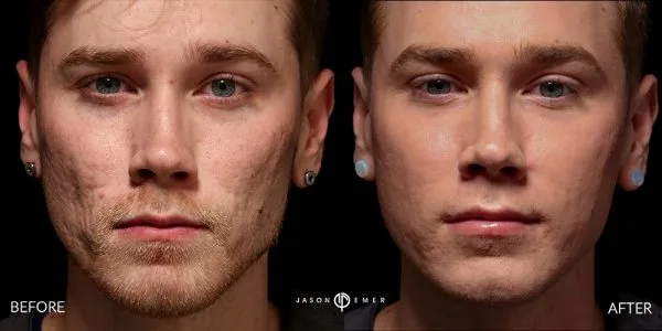 Chemical Peel | Before and After | Dr. Jason Emer MD | | Beverly Hills, CA