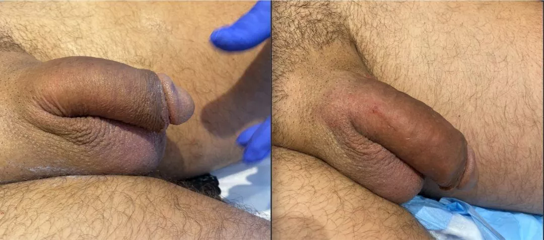 240220-1of3-1080x477 Penile Fat Injection