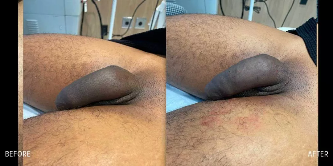 240345-2of2-1080x540 Penile Fat Transfer