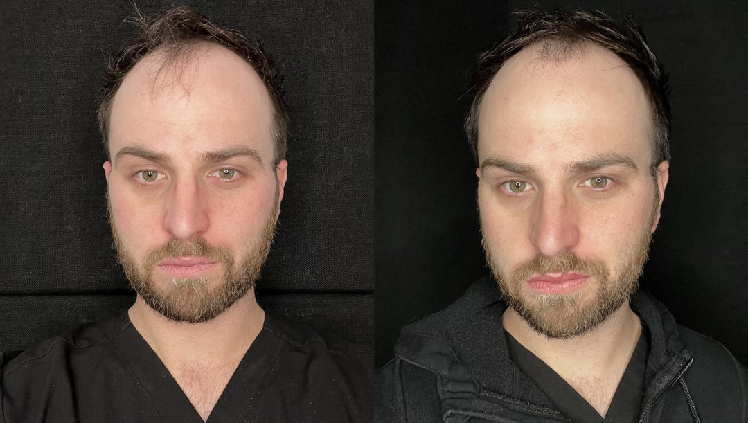 BOTOX-bxa-1-1080x611