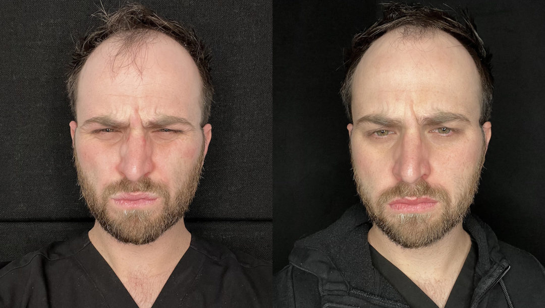 BOTOX-bxa3-1-1080x611