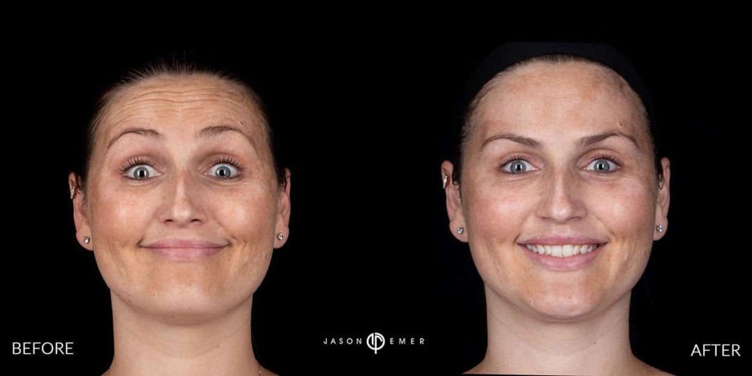 Botox-before-and-after_01-1080x540