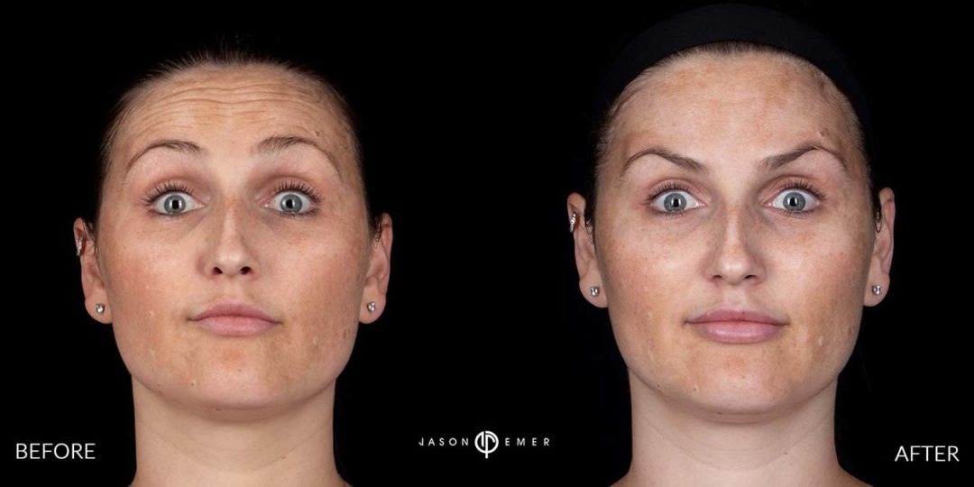 Botox-before-and-after_02-1080x540